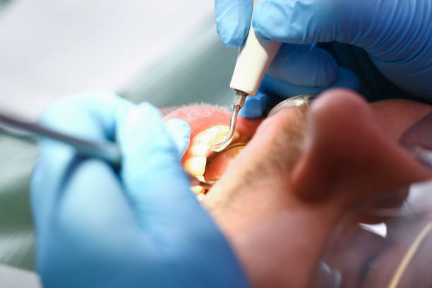 Best Chipped Tooth Repair Near Me  in Thermopolis, WY