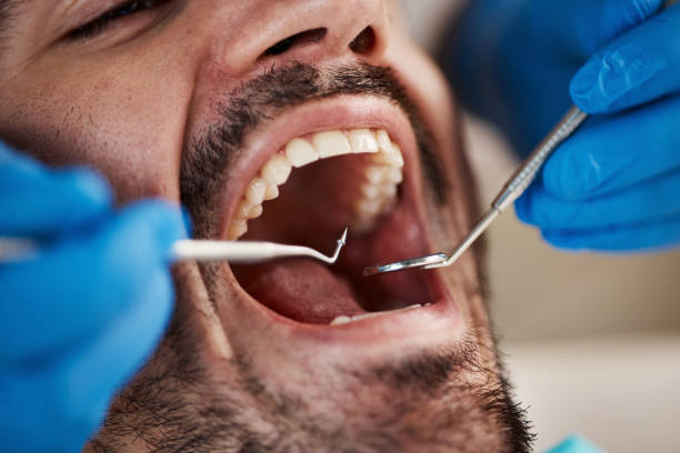 Emergency Dental Filling Replacement in WY